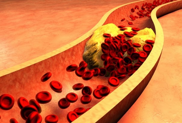 علل افزایش چربی خون و راههای درمان در طب سنتی