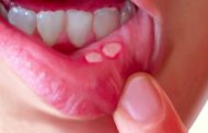 علل آفت دهان و درمان آن در طب سنتی