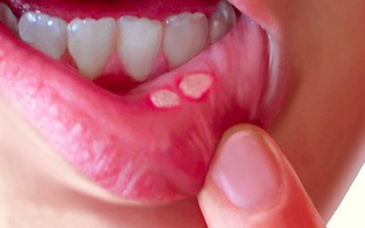 علل آفت دهان و درمان آن در طب سنتی