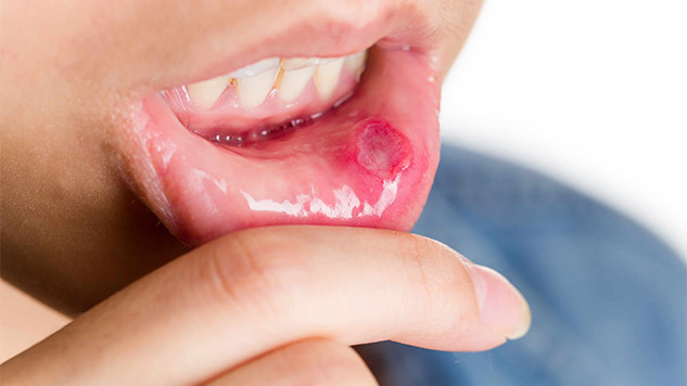 درمان آفت دهان با طب سنتی