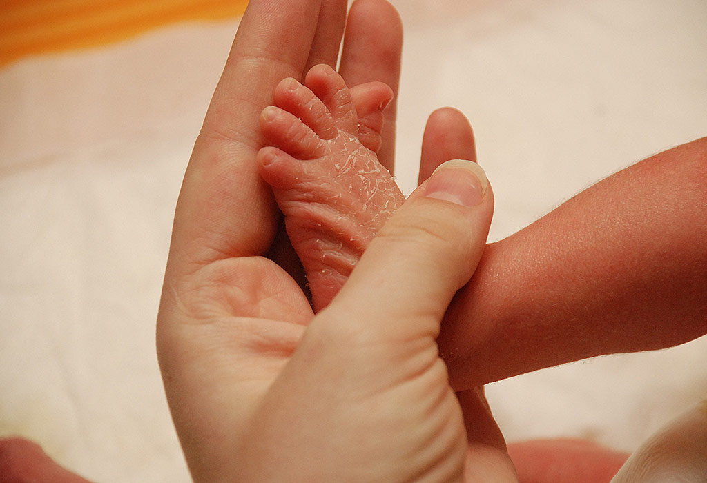 درمان خشکی پوست نوزاد در طب سنتی