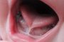 درمان آبریزش دهان در طب سنتی