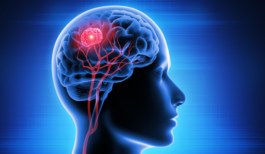 درمان تومور مغزی با طب سنتی