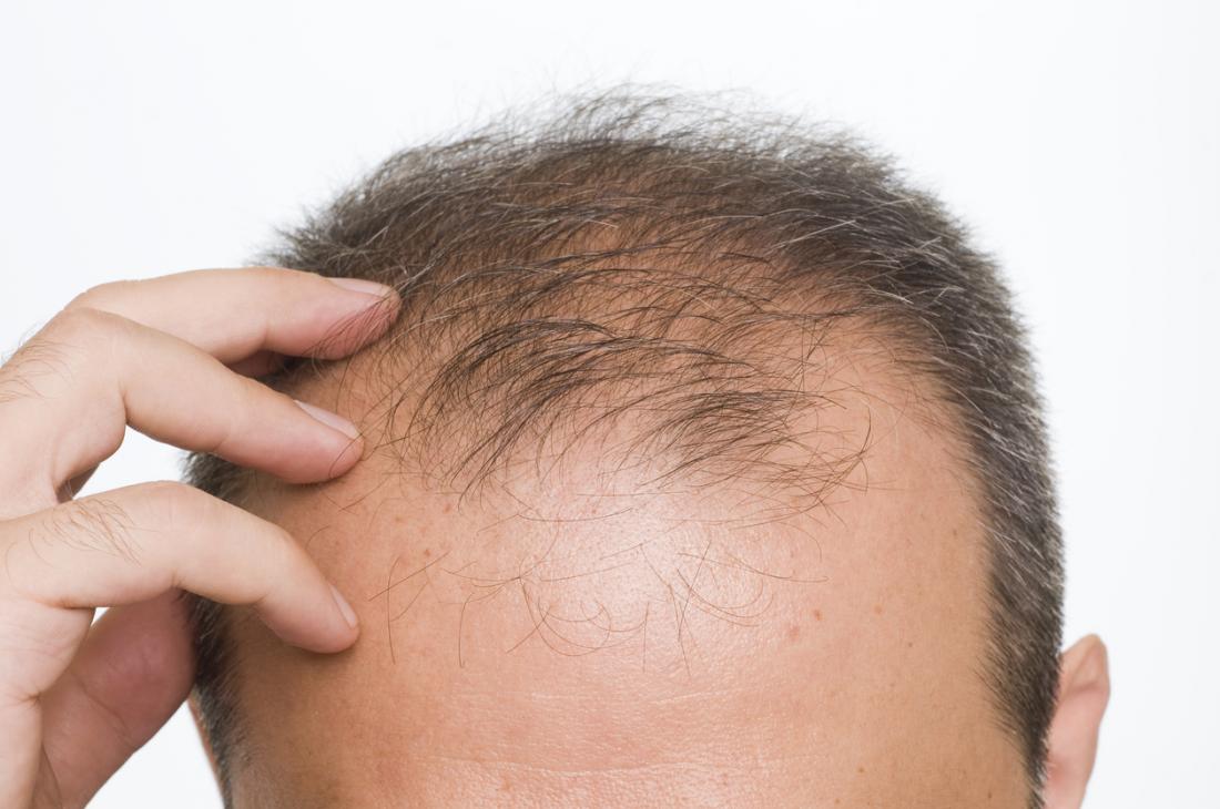 درمان ریزش مو بر اثر کم کاری کبد در طب سنتی
