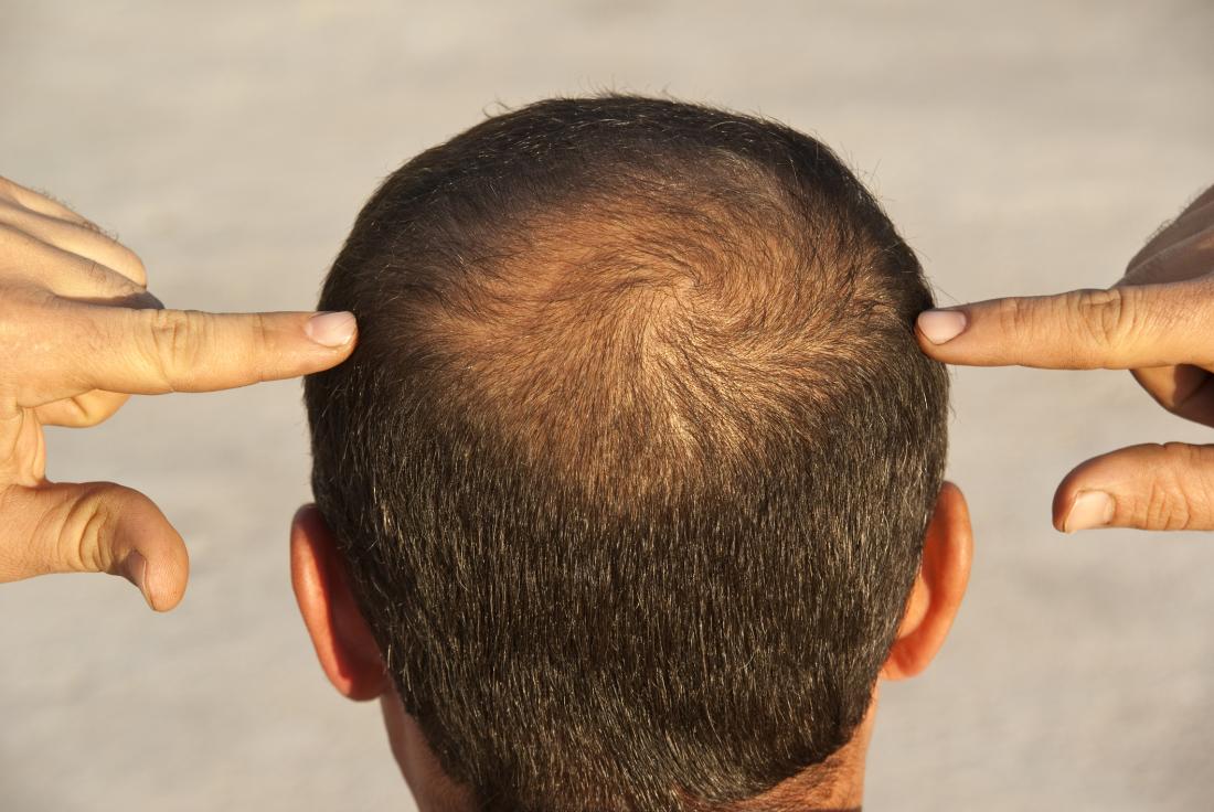 جلوگیری از ریزش مو در طب سنتی