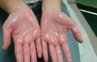 درمان عرق کف دست با طب سنتی