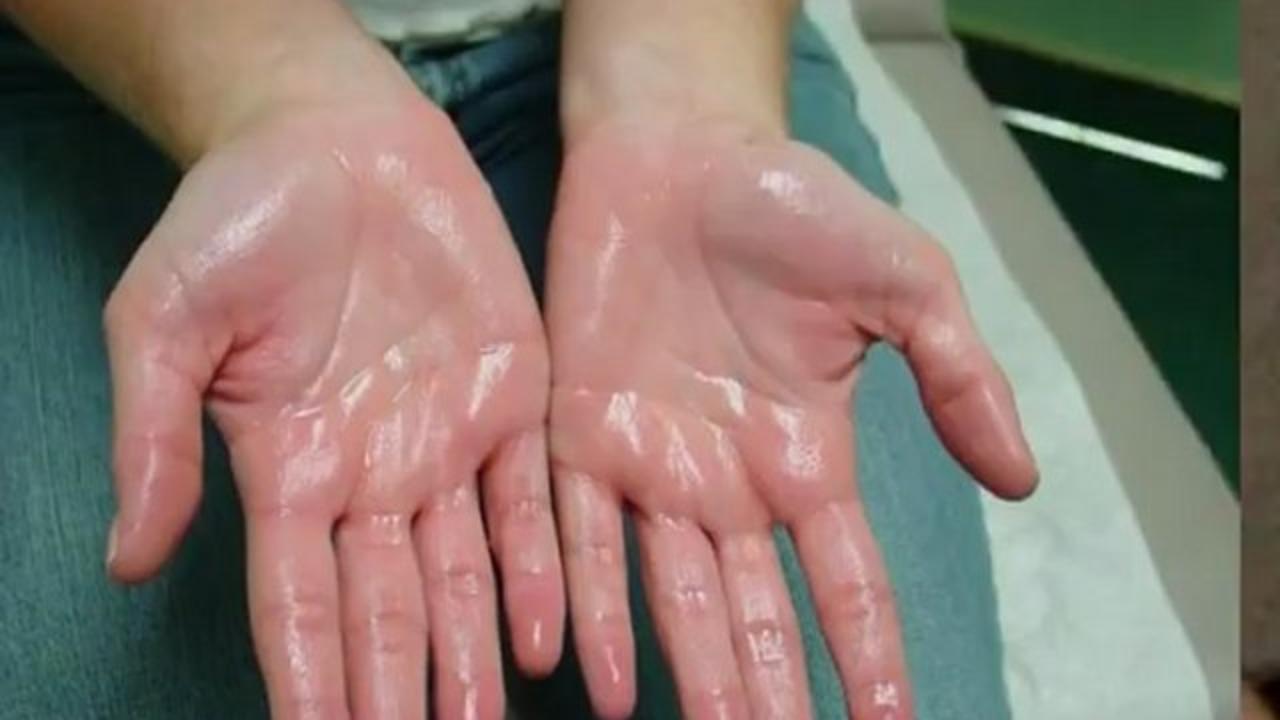درمان عرق کف دست با طب سنتی